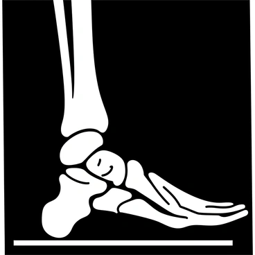 An x-ray image showing a human foot from a lateral view. The bones of the foot are clearly visible, with a noticeable fracture located in one of the metatarsals. The surrounding bones, including the phalanges and the tarsals, are also depicted in detail, highlighting their structure. The image presents a stark contrast between the dense white of the bones and the darker background of the x-ray film.