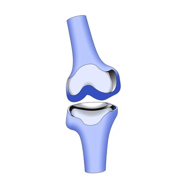 A perfectly fitted knee joint replacement is displayed in detail, showcasing the intricate components of the prosthetic. The joint is positioned in a way that highlights its alignment with the surrounding tibia and femur. Metal and plastic components are represented clearly, demonstrating the connection points and surface textures. The alignment of the axis of the knee is precise, indicating ideal positioning for optimal functionality. The surrounding anatomy, such as ligaments and cartilage remnants, is also depicted to provide context for the replacement joint.